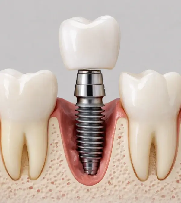 Implantes dentários